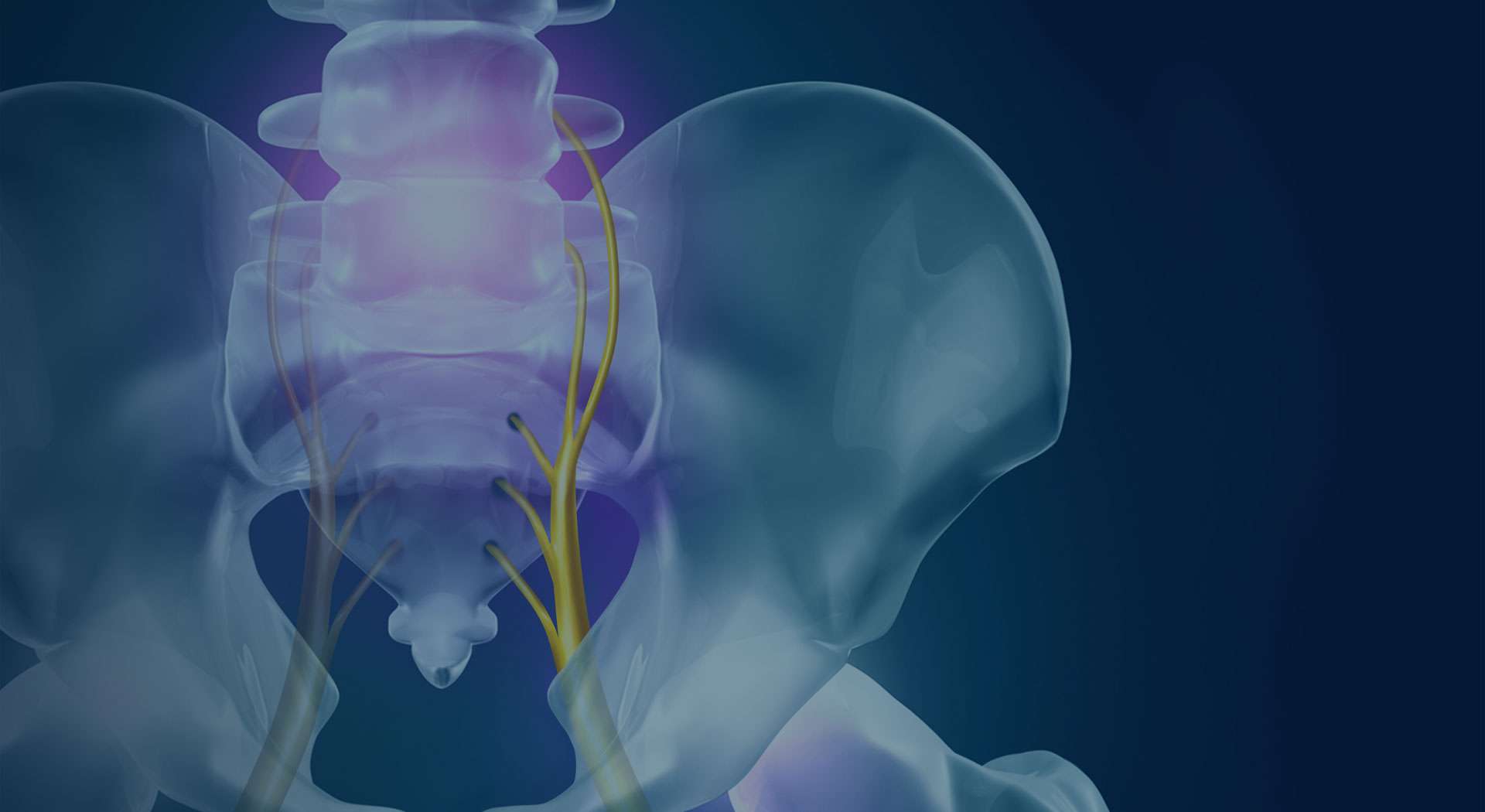 Nerve “flossing” for sciatica