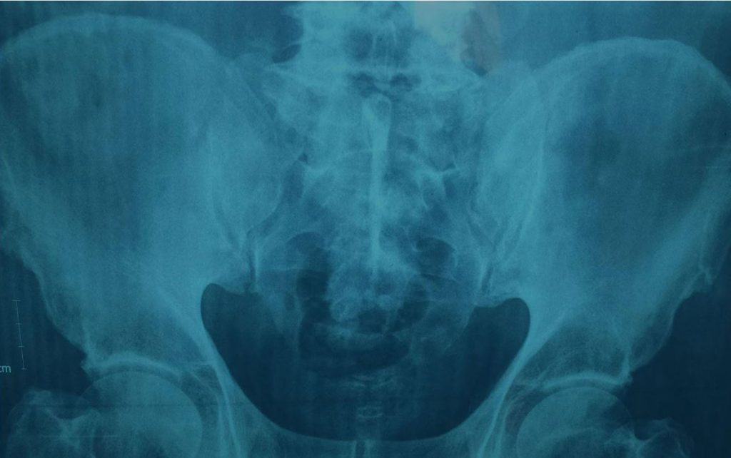 hip osteo